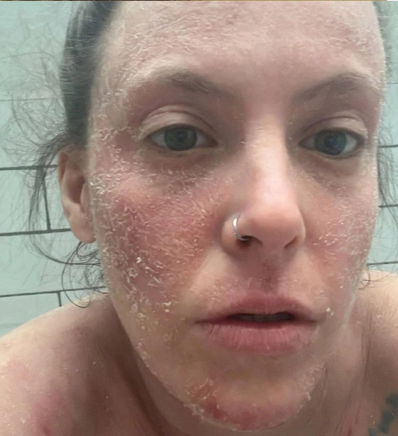 تمتنع عن مغادرة المنزل بسبب كريم للأكزيما ! صورة رقم 4