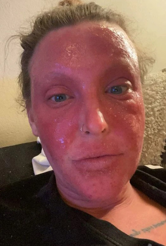 تمتنع عن مغادرة المنزل بسبب كريم للأكزيما ! صورة رقم 5