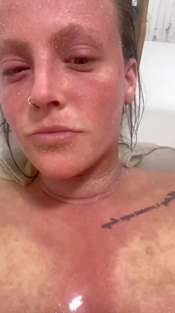 تمتنع عن مغادرة المنزل بسبب كريم للأكزيما ! صورة رقم 6