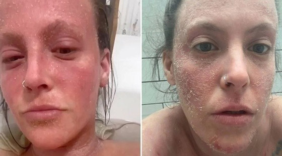 تمتنع عن مغادرة المنزل بسبب كريم للأكزيما ! صورة رقم 1