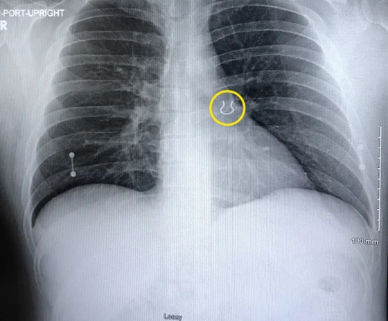 يعثر على حلقة أنف فقدها من 5 سنوات في رئته صورة رقم 3