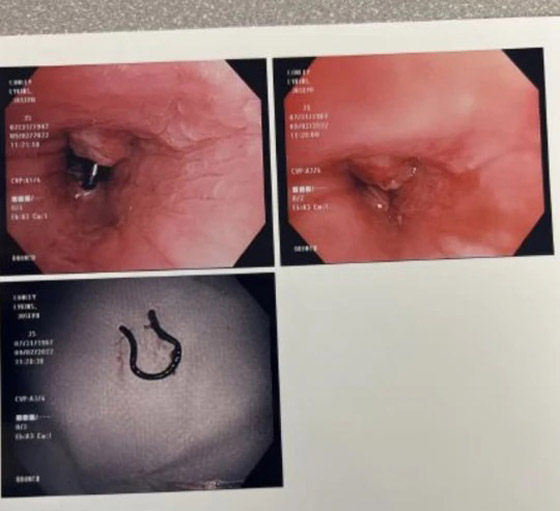 يعثر على حلقة أنف فقدها من 5 سنوات في رئته صورة رقم 4