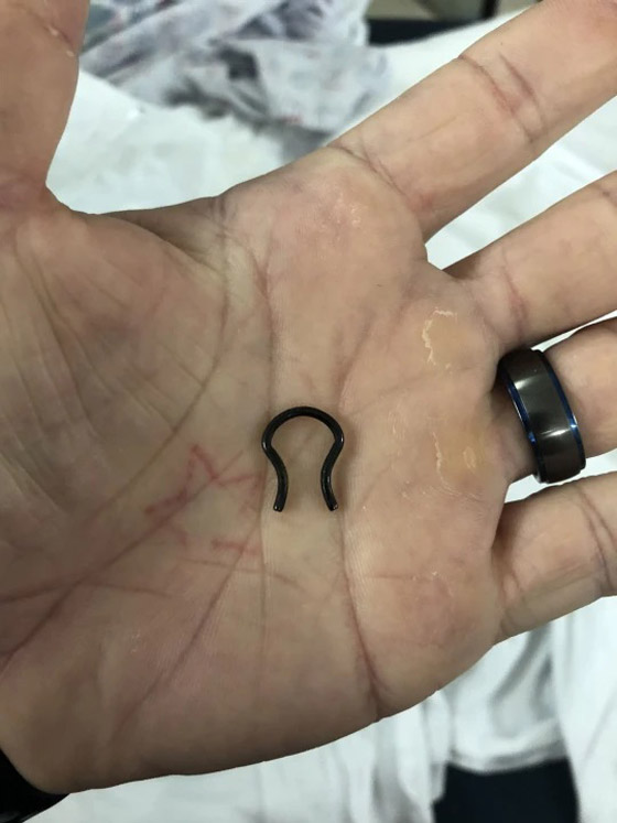 يعثر على حلقة أنف فقدها من 5 سنوات في رئته صورة رقم 5