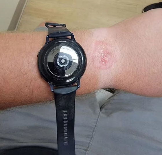 ساعة سامسونغ تتسبب في حروق لمستخدم أثناء نومه صورة رقم 2