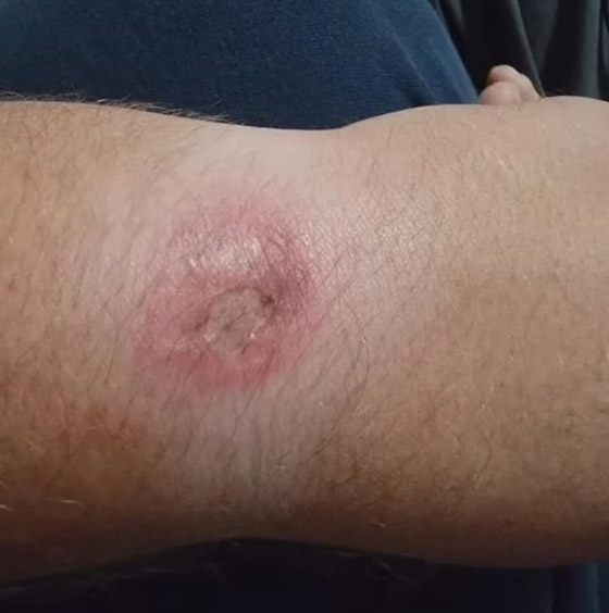 ساعة سامسونغ تتسبب في حروق لمستخدم أثناء نومه صورة رقم 3