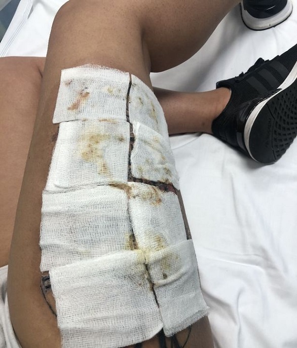  ! تكاد تفقد ساقها بسبب وشم صورة رقم 2