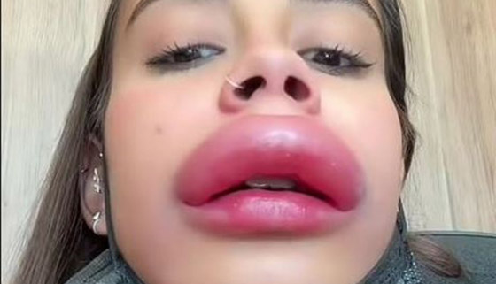 حقنة بوتوكس تشوه وجه فتاة بشكل مخيف صورة رقم 1