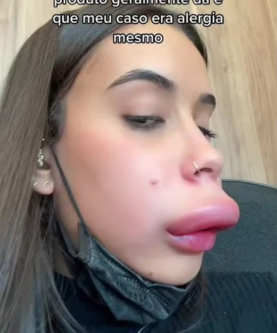 حقنة بوتوكس تشوه وجه فتاة بشكل مخيف صورة رقم 2