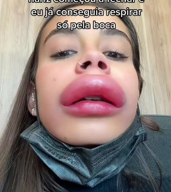 حقنة بوتوكس تشوه وجه فتاة بشكل مخيف صورة رقم 3