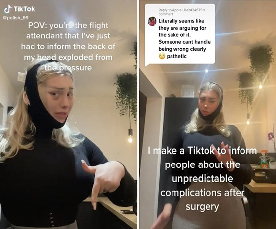 تنفجر مؤخرة رأسها بسبب ضغط الهواء في الطائرة صورة رقم 2