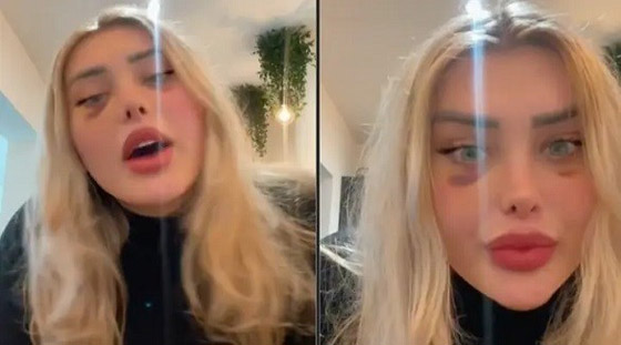 تنفجر مؤخرة رأسها بسبب ضغط الهواء في الطائرة صورة رقم 1