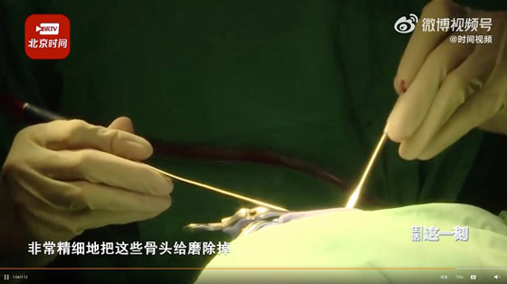 تكتشف أنها مصابة بمرض خطير بسبب كتلة شعر في ظهرها صورة رقم 2