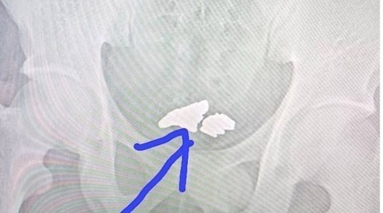 يبتلع كمية كبيرة من الذهب محاولاً تهريبها .. والنتيجة؟ صورة رقم 1