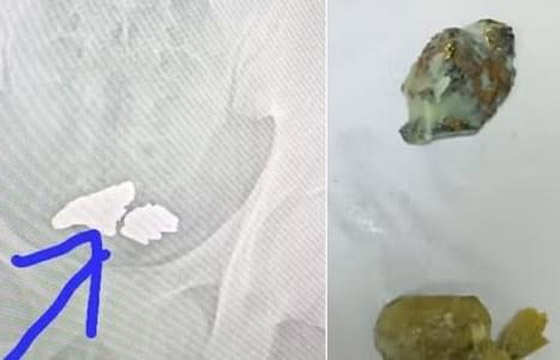 يبتلع كمية كبيرة من الذهب محاولاً تهريبها .. والنتيجة؟ صورة رقم 5