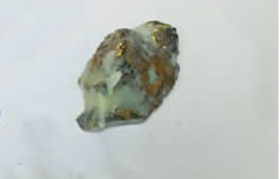 يبتلع كمية كبيرة من الذهب محاولاً تهريبها .. والنتيجة؟ صورة رقم 2