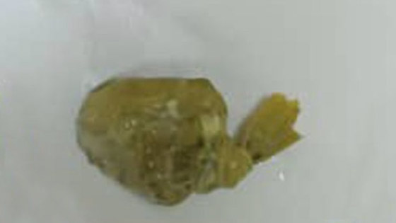 يبتلع كمية كبيرة من الذهب محاولاً تهريبها .. والنتيجة؟ صورة رقم 3