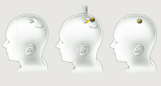 إيلون ماسك: بدء زرع رقاقة لاسلكية بدماغ الإنسان خلال 6 أشهر صورة رقم 11