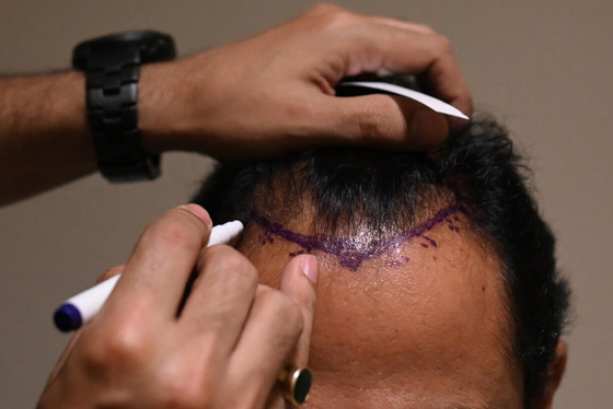 يجريها هواة على يوتيوب! عملية زراعة الشعر تتسبب بمقتل رجل هندي صورة رقم 4 يجريها هواة على يوتيوب! عملية زراعة الشعر تتسبب بمقتل رجل هندي صورة رقم 4