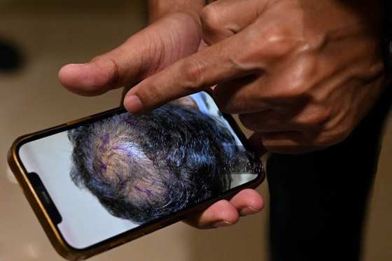يجريها هواة على يوتيوب! عملية زراعة الشعر تتسبب بمقتل رجل هندي صورة رقم 3 يجريها هواة على يوتيوب! عملية زراعة الشعر تتسبب بمقتل رجل هندي صورة رقم 3