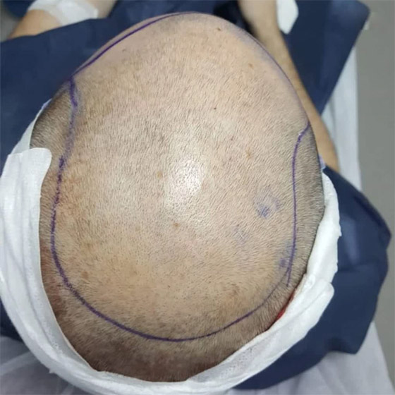 يجريها هواة على يوتيوب! عملية زراعة الشعر تتسبب بمقتل رجل هندي صورة رقم 1 يجريها هواة على يوتيوب! عملية زراعة الشعر تتسبب بمقتل رجل هندي صورة رقم 1