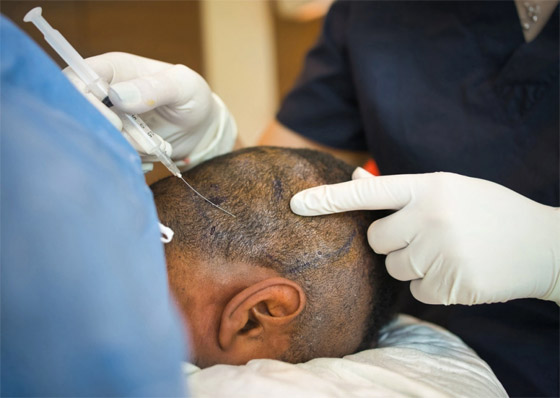 يجريها هواة على يوتيوب! عملية زراعة الشعر تتسبب بمقتل رجل هندي صورة رقم 2 يجريها هواة على يوتيوب! عملية زراعة الشعر تتسبب بمقتل رجل هندي صورة رقم 2