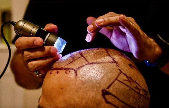 يجريها هواة على يوتيوب! عملية زراعة الشعر تتسبب بمقتل رجل هندي صورة رقم 5 يجريها هواة على يوتيوب! عملية زراعة الشعر تتسبب بمقتل رجل هندي صورة رقم 5