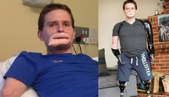 بكتيريا مرعبة فتكت بأطفال وبترت أطراف رجل وجعلته بفم غريب! صورة رقم 1 بكتيريا مرعبة فتكت بأطفال وبترت أطراف رجل وجعلته بفم غريب! صورة رقم 1