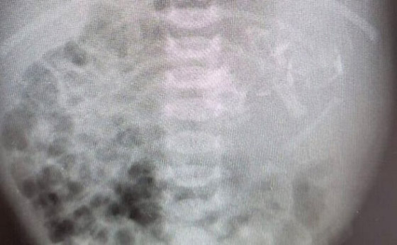 طفلة تولد بحالة نادرة بعد العثور على توأمها داخل معدتها صورة رقم 1