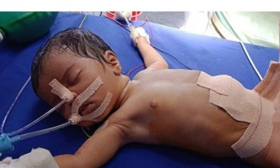 طفلة تولد بحالة نادرة بعد العثور على توأمها داخل معدتها صورة رقم 3