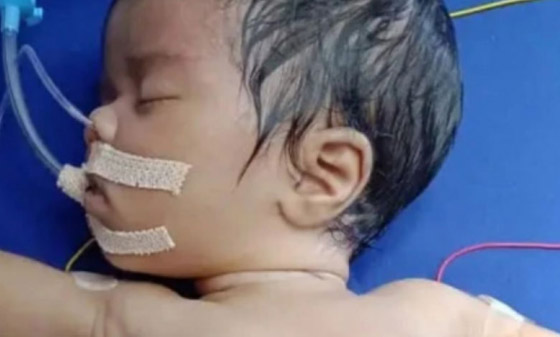 طفلة تولد بحالة نادرة بعد العثور على توأمها داخل معدتها صورة رقم 5