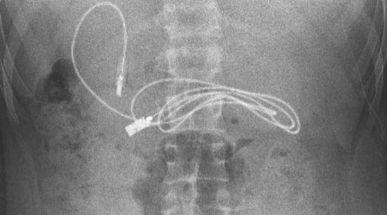 أطباء يستخرجون سلك شاحن هاتف...من معدة مراهق صورة رقم 1