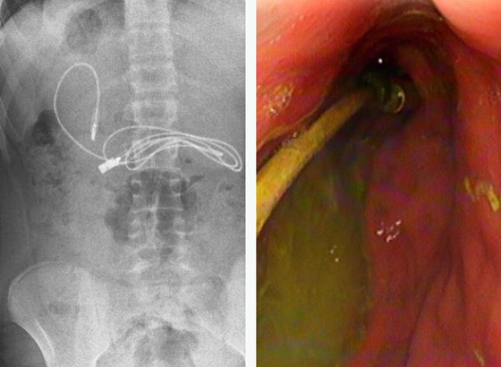 أطباء يستخرجون سلك شاحن هاتف...من معدة مراهق صورة رقم 3