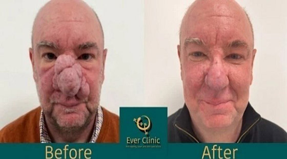 تخليص اسكتلندي من أنفه الضخم بالليزر صورة رقم 1