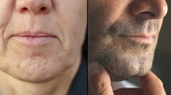 خيبة أمل... بعد معرفة سبب تشكل غمازات الذقن صورة رقم 2