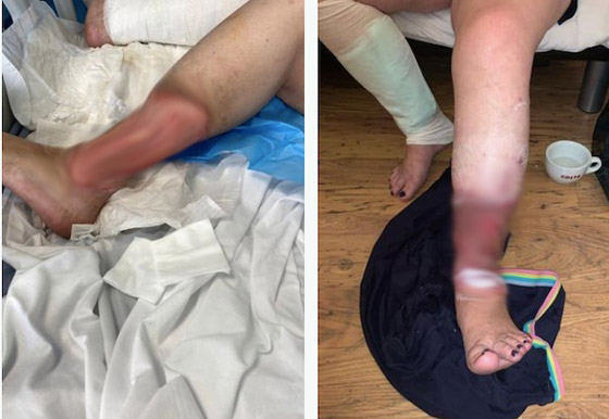 لدغة بعوضة كادت تبتر رجليها صورة رقم 2