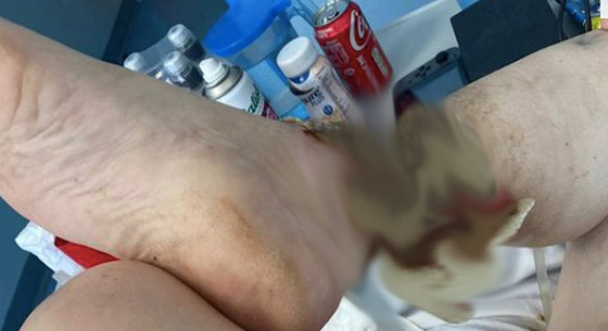 لدغة بعوضة كادت تبتر رجليها صورة رقم 3