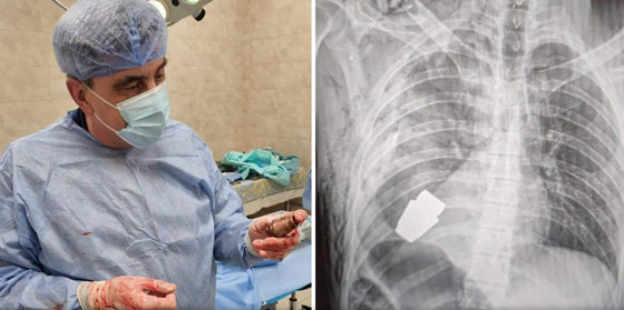 معجزة طبية.. نجاح عملية استئصال قنبلة من جسم جندي أوكراني صورة رقم 1 معجزة طبية.. نجاح عملية استئصال قنبلة من جسم جندي أوكراني صورة رقم 1