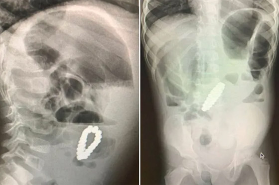 العثور على أسورة مغناطيسية داخل معدة طفل عانى من إمساك! صور صورة رقم 1 العثور على أسورة مغناطيسية داخل معدة طفل عانى من إمساك! صور صورة رقم 1
