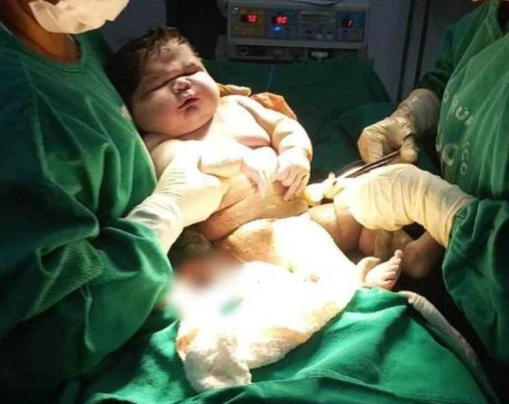 أضخم مولود في العالم! امرأة برازيلية تُنجب طفلا بوزن أضخم مولود في العالم! امرأة برازيلية تُنجب طفلا بوزن