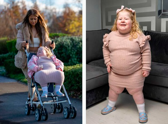 تمنع طفلتها من دخول المطبخ بسبب حالة نادرة صورة رقم 2