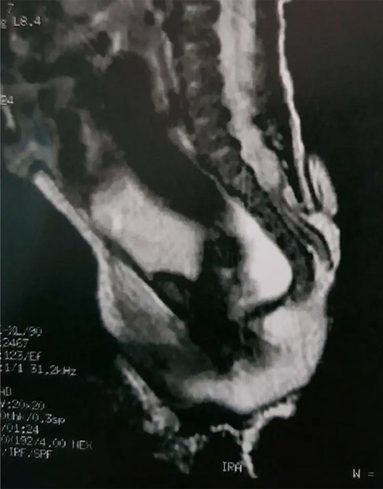 ظاهرة نادرة.. طفلة برازيلية ولدت بذيل طوله 6 سم! صور صورة رقم 2