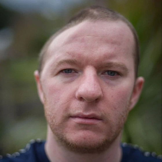 لكمة واحدة تُفقده نصف جمجمته ! صورة رقم 2 لكمة واحدة تُفقده نصف جمجمته ! صورة رقم 2