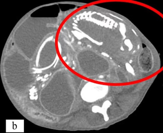 وفاة امرأة من سوء التغذية بسبب جنين غير مولود صورة رقم 2