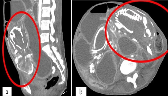وفاة امرأة من سوء التغذية بسبب جنين غير مولود صورة رقم 1