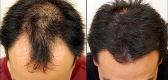 لعلاج تساقط الشعر.. إليك 7 طرق طبيعية فعالة صورة رقم 7