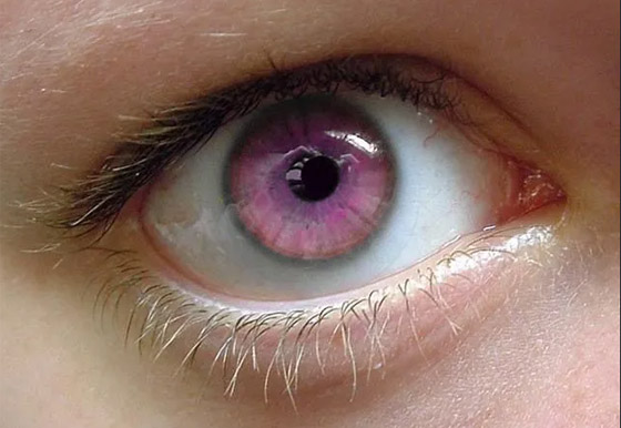 تعرف إلى 6 من أندر ألوان العيون وأكثرها غرابة في العالم! صورة رقم 3