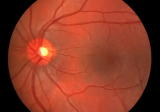 علاج جيني قد يعيد البصر للمكفوفين وراثيا! صورة رقم 1