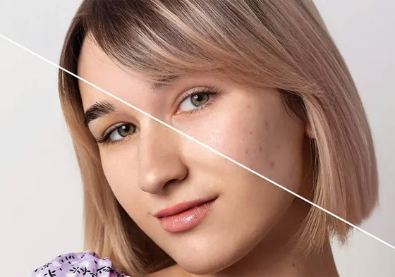 إليكم 8 حلول جذرية للقضاء على مشكلة توسع المسام صورة رقم 1