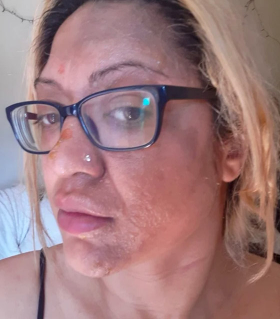 بيضة تشوه وجه امرأة بسبب حيلة على تيك توك صورة رقم 4