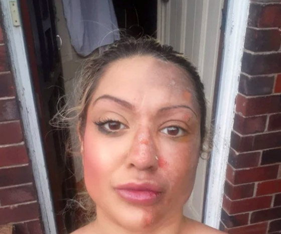 بيضة تشوه وجه امرأة بسبب حيلة على تيك توك صورة رقم 3